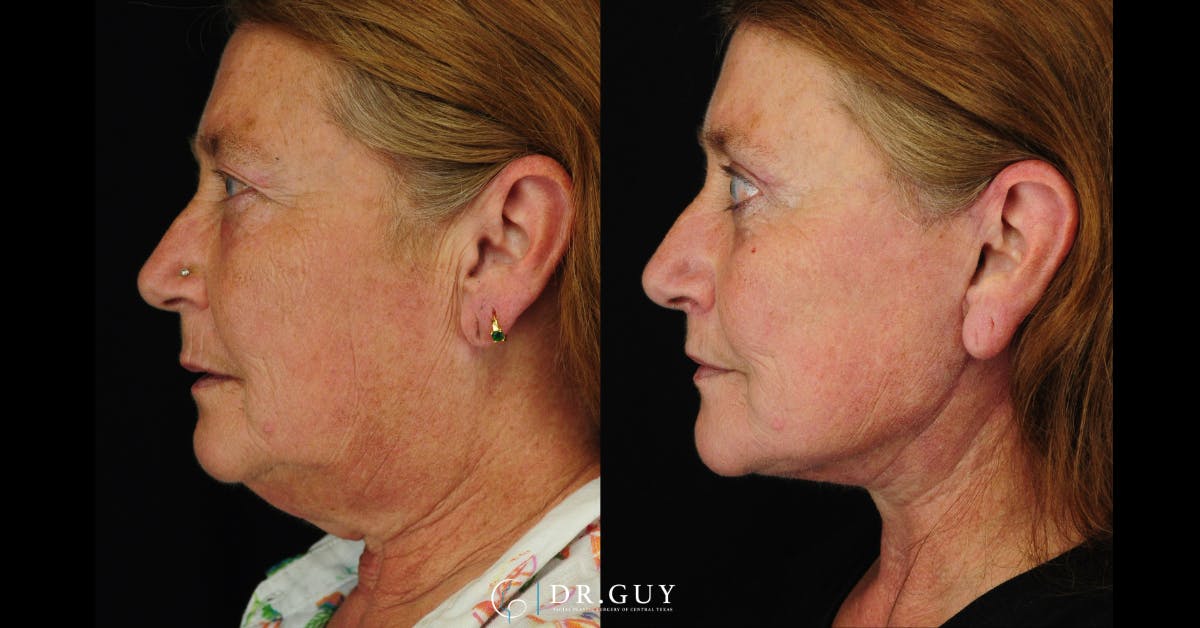 Facelift Before & After Gallery - Patient 186393 - Image 4