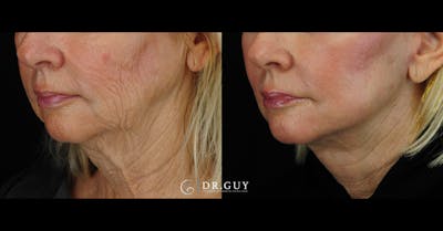 Facelift Before & After Gallery - Patient 988465 - Image 1