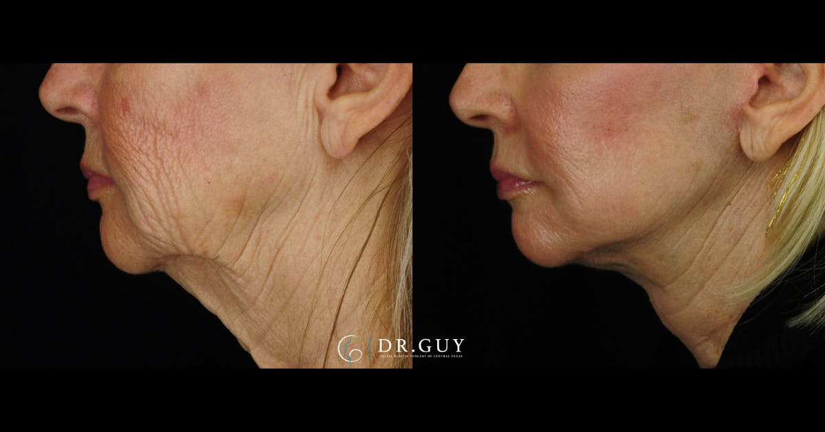 Facelift Before & After Gallery - Patient 988465 - Image 4