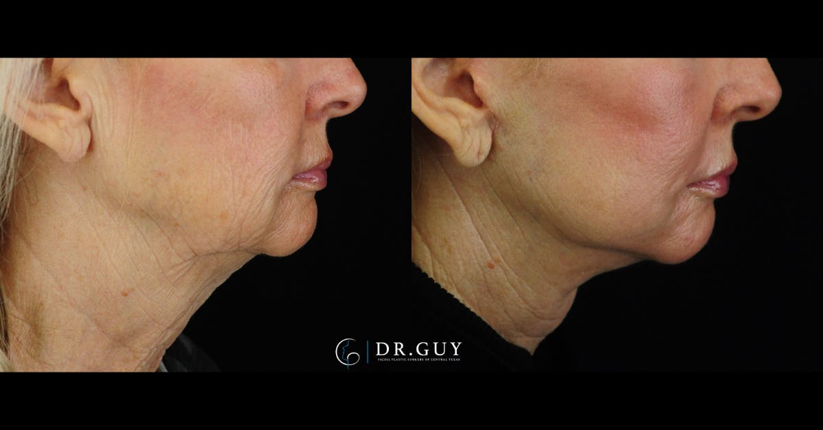 Facelift Before & After Gallery - Patient 988465 - Image 5