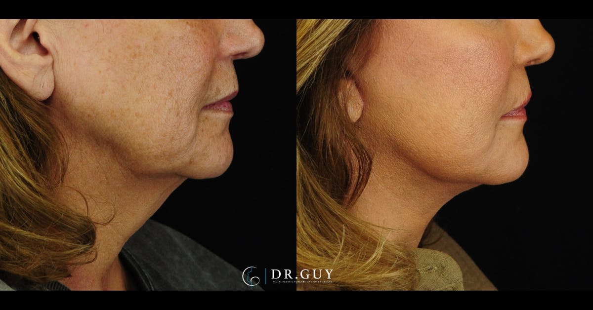 Facelift Before & After Gallery - Patient 104765 - Image 1