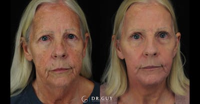 Facelift Before & After Gallery - Patient 223984 - Image 1