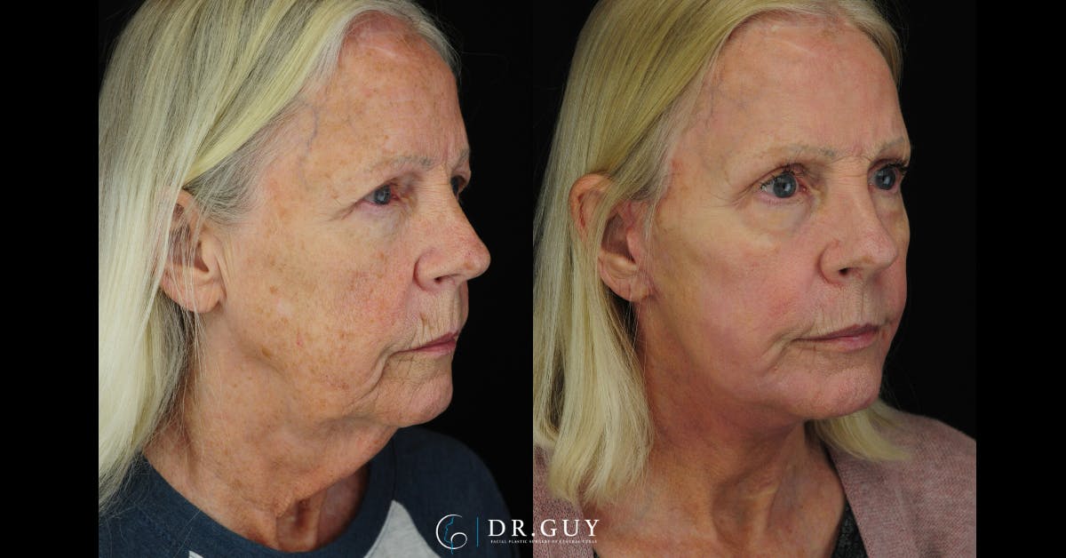 Facelift Before & After Gallery - Patient 223984 - Image 4