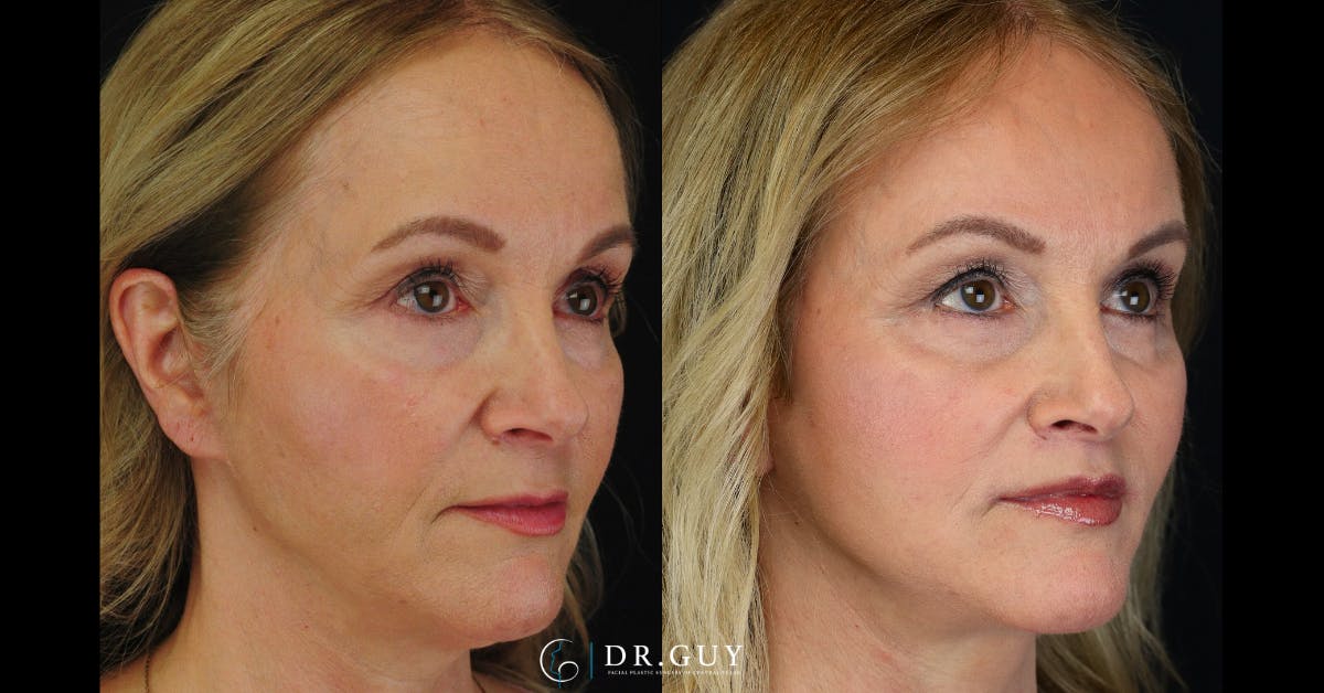 Facelift Before & After Gallery - Patient 364565 - Image 4