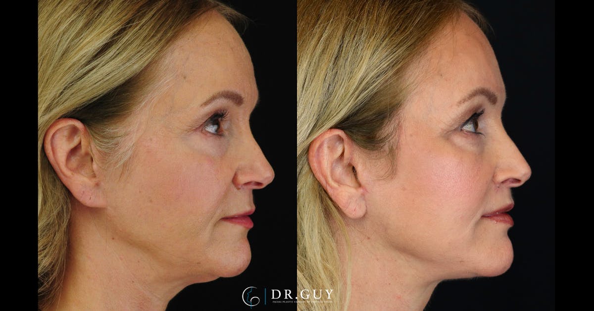 Facelift Before & After Gallery - Patient 364565 - Image 5