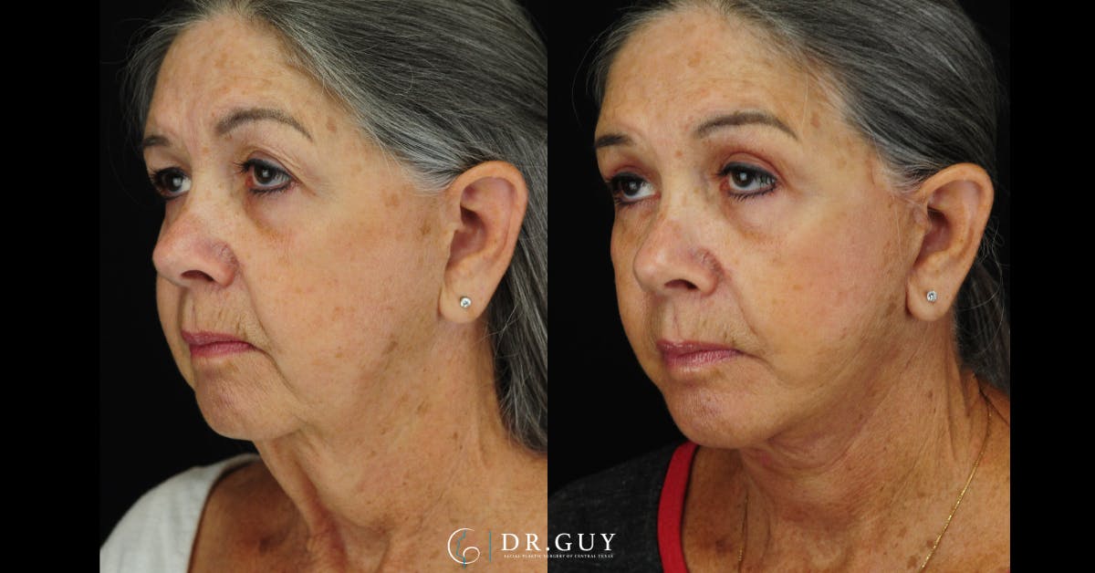 Facelift Before & After Gallery - Patient 383738 - Image 1