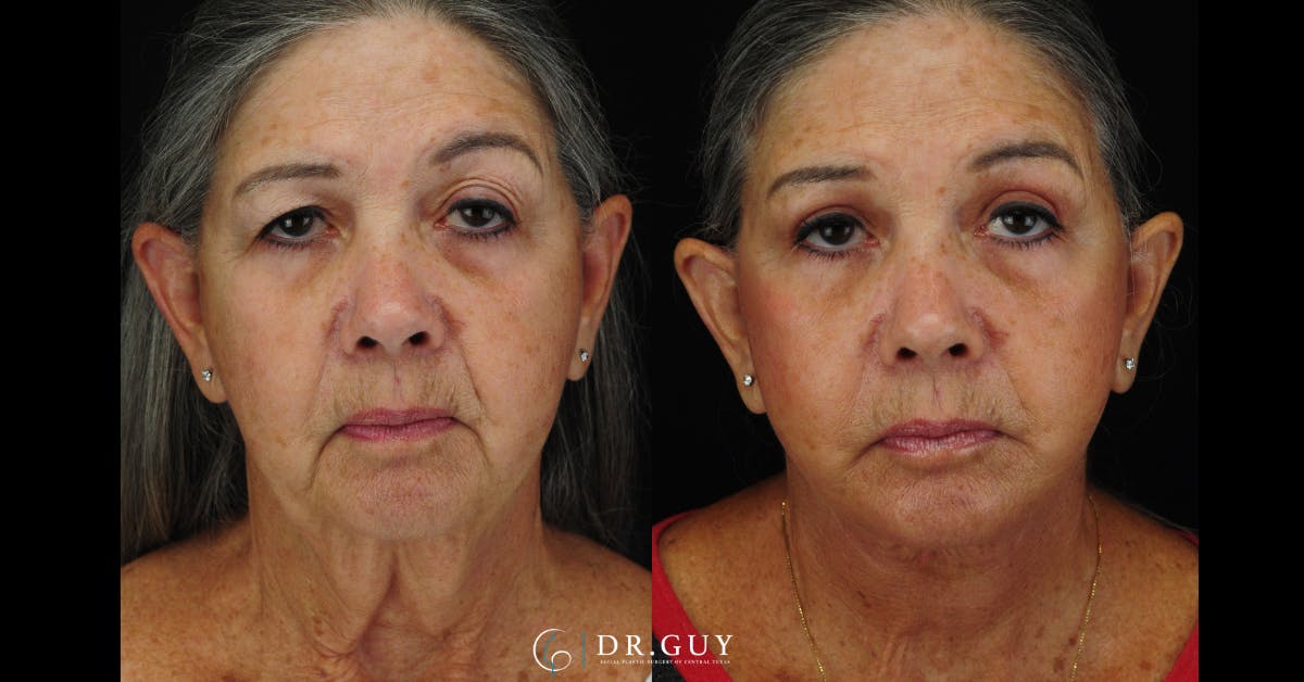Facelift Before & After Gallery - Patient 383738 - Image 3
