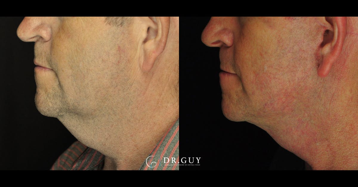 Facelift Before & After Gallery - Patient 303016 - Image 5