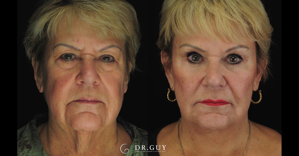 Facelift Before & After Gallery - Patient 164129 - Image 1