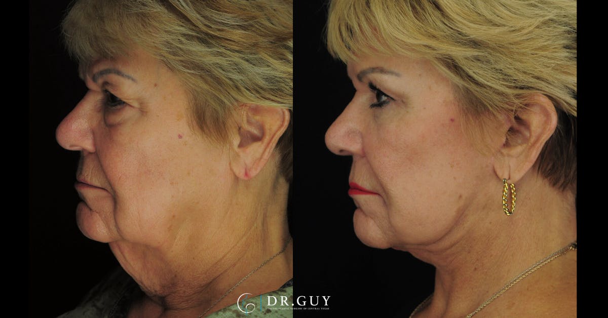 Facelift Before & After Gallery - Patient 164129 - Image 3