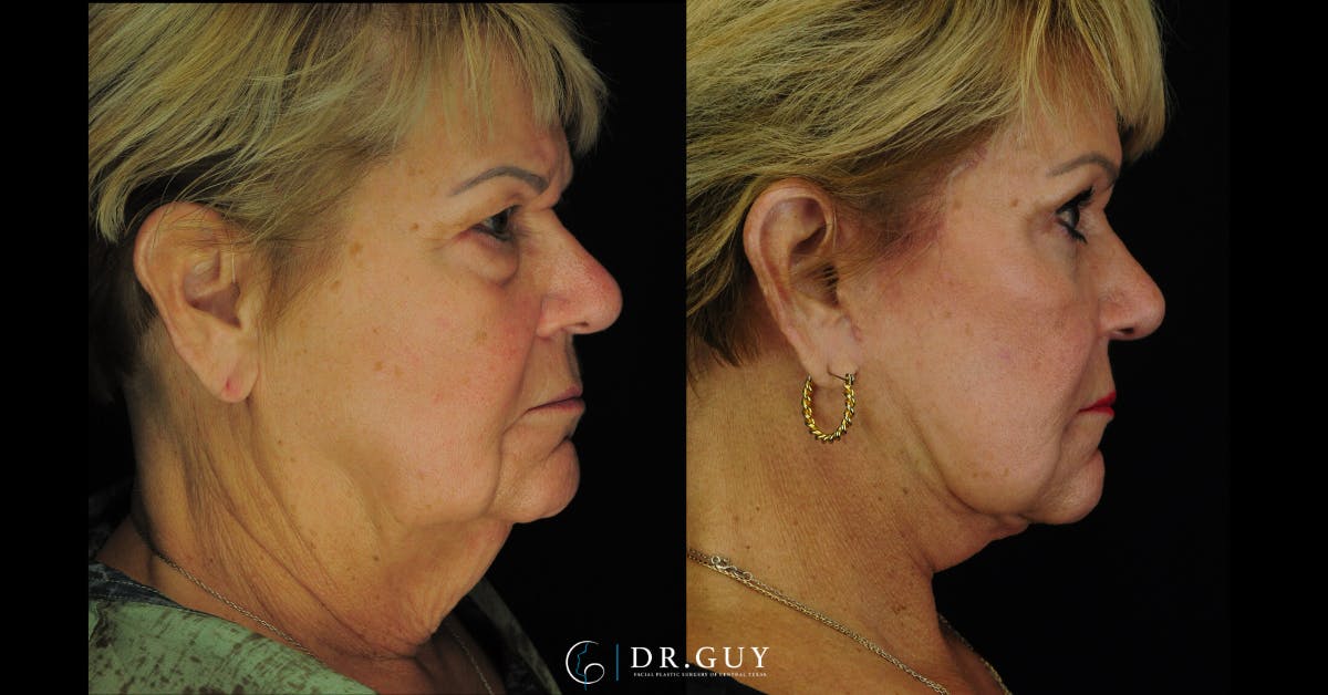 Facelift Before & After Gallery - Patient 164129 - Image 5
