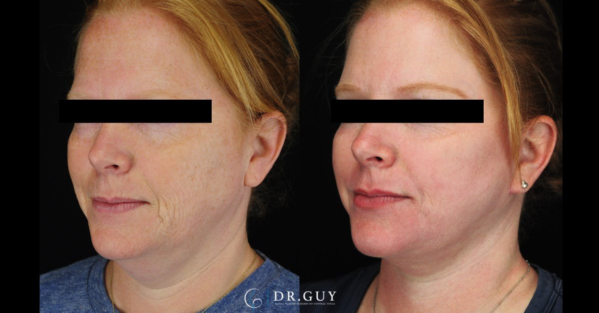 Facelift Before & After Gallery - Patient 266412 - Image 2