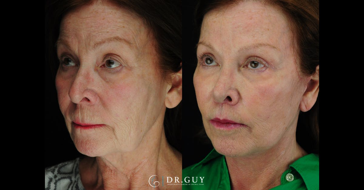 Facelift Before & After Gallery - Patient 373118 - Image 1