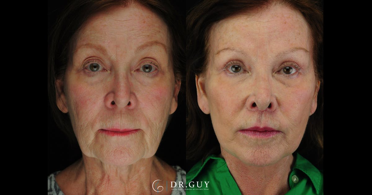Facelift Before & After Gallery - Patient 373118 - Image 2