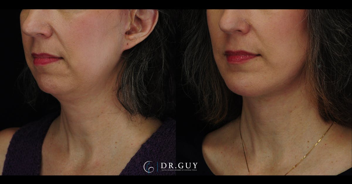 Facelift Before & After Gallery - Patient 360344 - Image 2