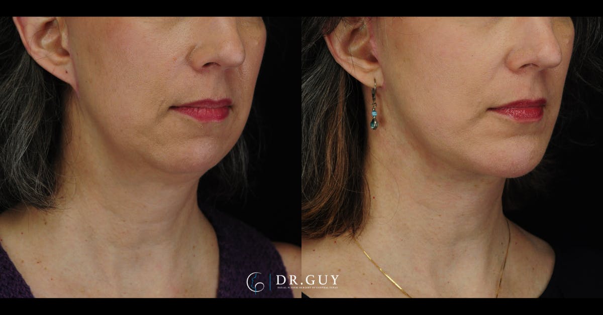 Facelift Before & After Gallery - Patient 360344 - Image 4