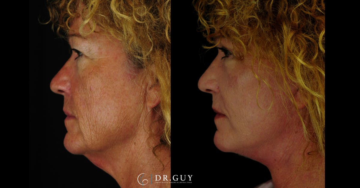 Facelift Before & After Gallery - Patient 177140 - Image 1