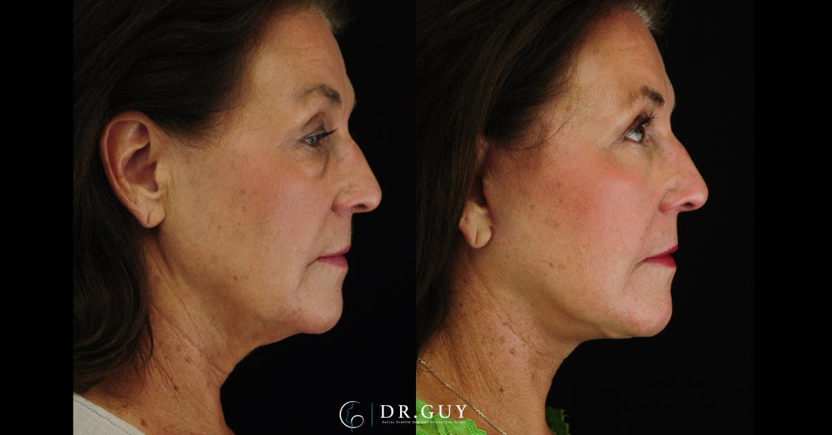 Facelift Before & After Gallery - Patient 340907 - Image 5