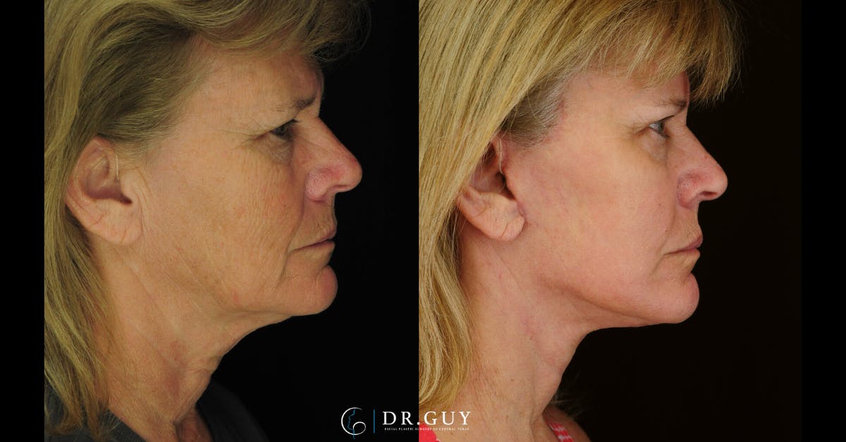 Facelift Before & After Gallery - Patient 310670 - Image 2