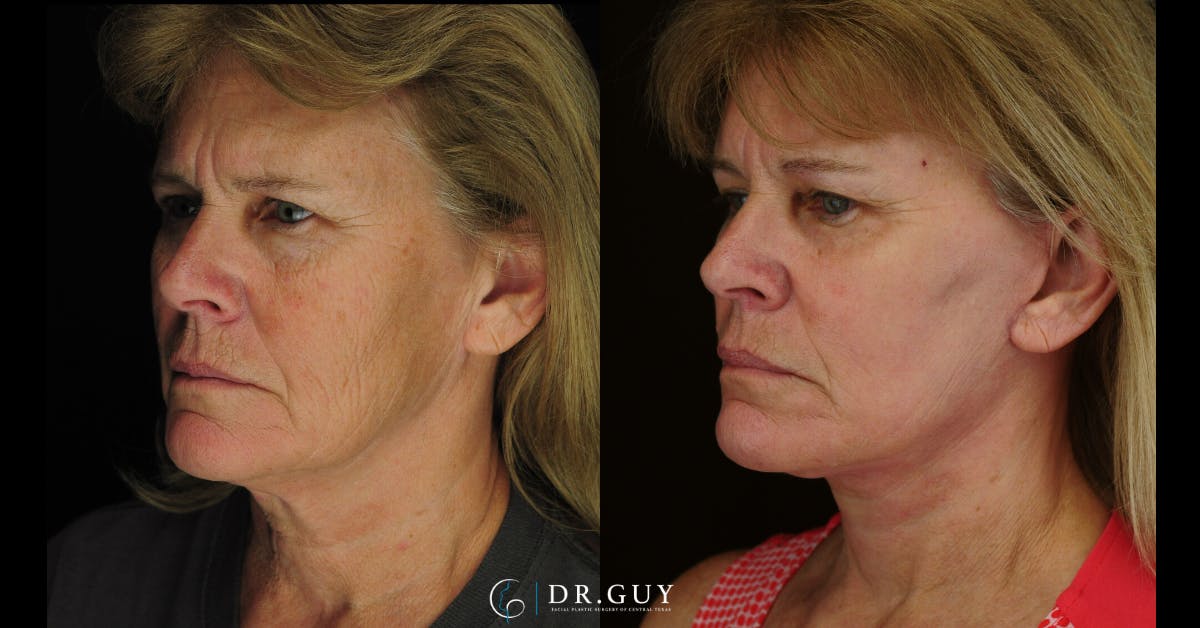 Facelift Before & After Gallery - Patient 310670 - Image 4
