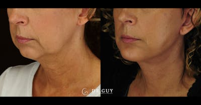 Facelift Before & After Gallery - Patient 327605 - Image 1