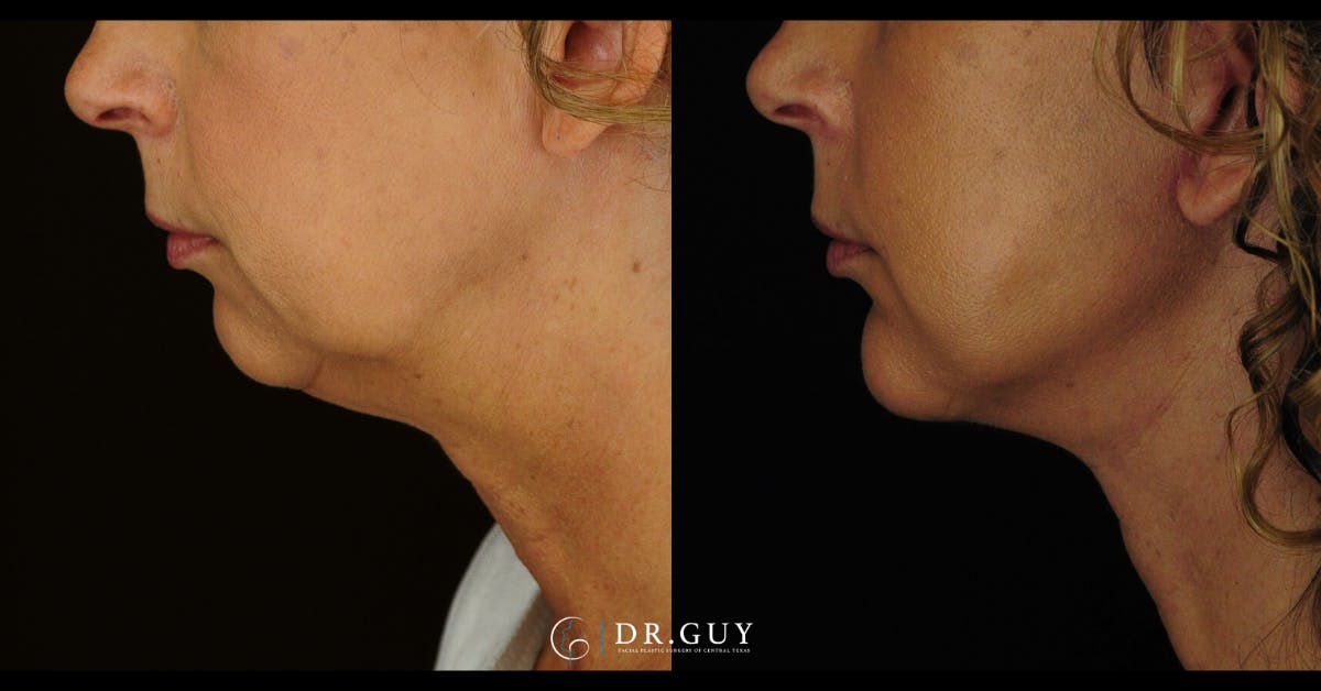 Facelift Before & After Gallery - Patient 327605 - Image 2