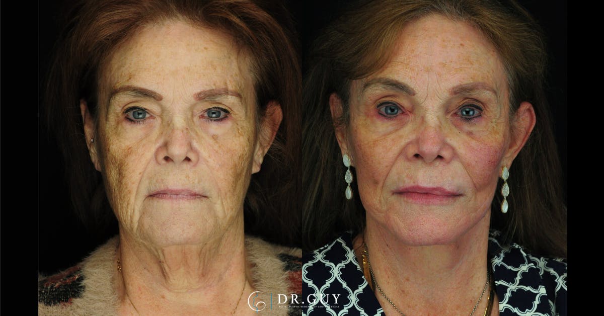 Facelift Before & After Gallery - Patient 268300 - Image 3