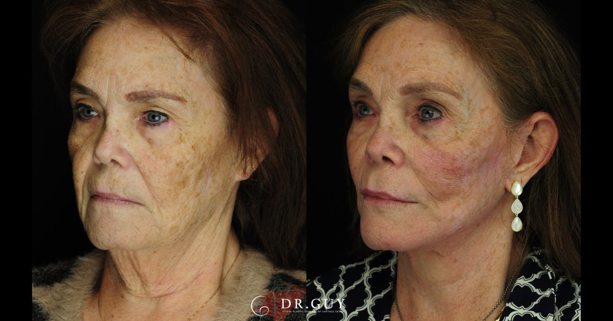 Facelift Before & After Gallery - Patient 268300 - Image 4