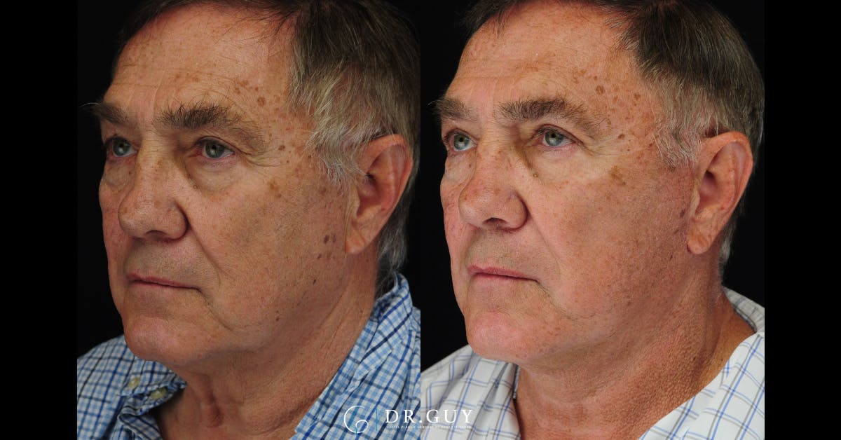 Facelift Before & After Gallery - Patient 240703 - Image 1