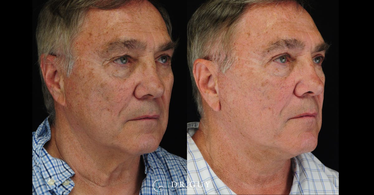 Facelift Before & After Gallery - Patient 240703 - Image 2