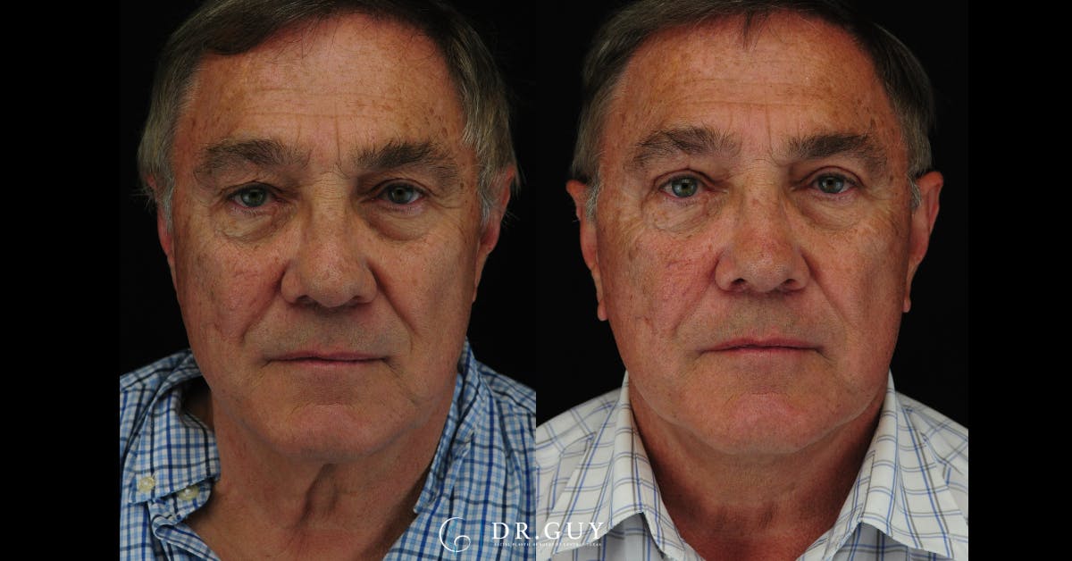 Facelift Before & After Gallery - Patient 240703 - Image 3