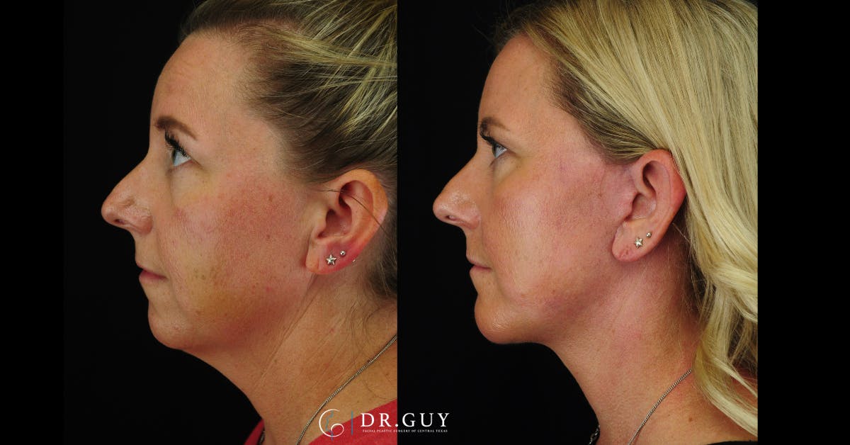 Facelift Before & After Gallery - Patient 356335 - Image 1