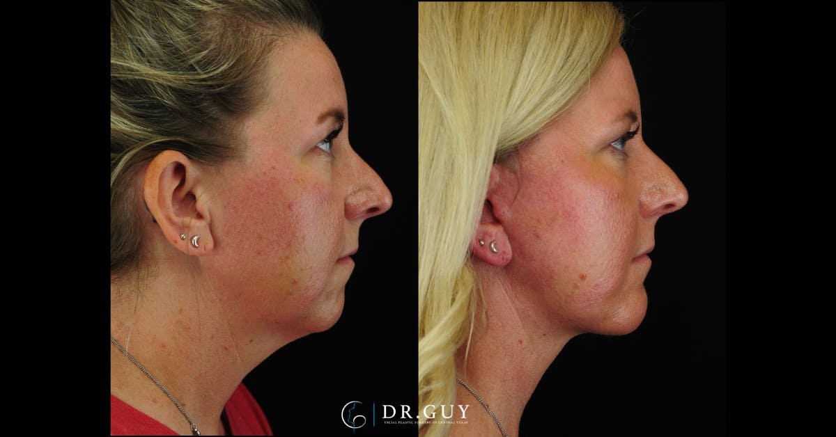 Facelift Before & After Gallery - Patient 356335 - Image 2