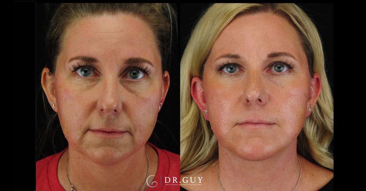 Facelift Before & After Gallery - Patient 356335 - Image 3