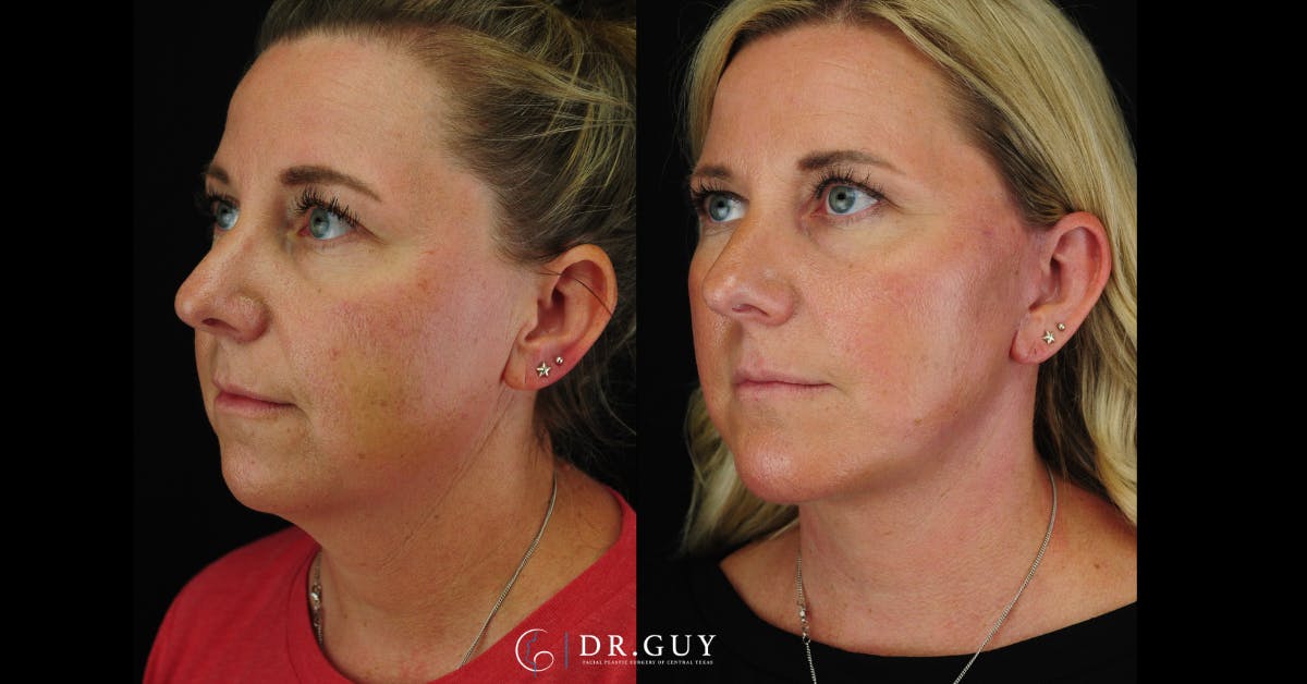 Facelift Before & After Gallery - Patient 356335 - Image 4