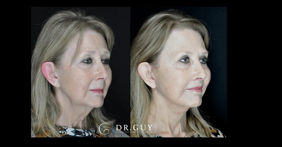Facelift Before & After Gallery - Patient 444348 - Image 2