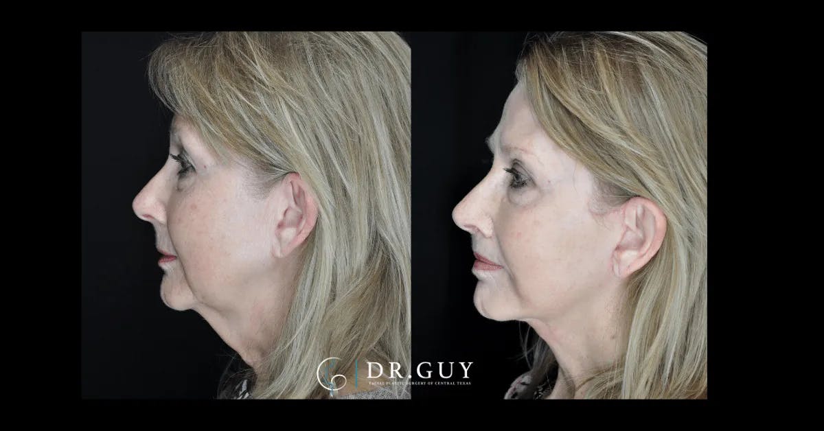 Facelift Before & After Gallery - Patient 444348 - Image 4