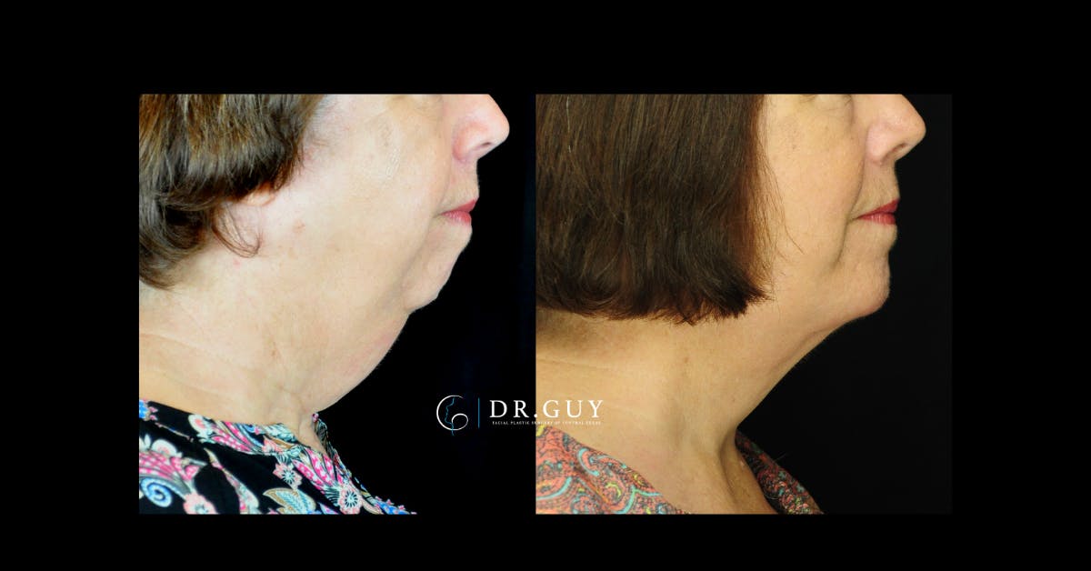 Facelift Before & After Gallery - Patient 311466 - Image 2