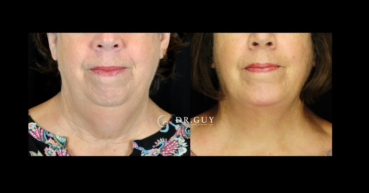 Facelift Before & After Gallery - Patient 311466 - Image 3