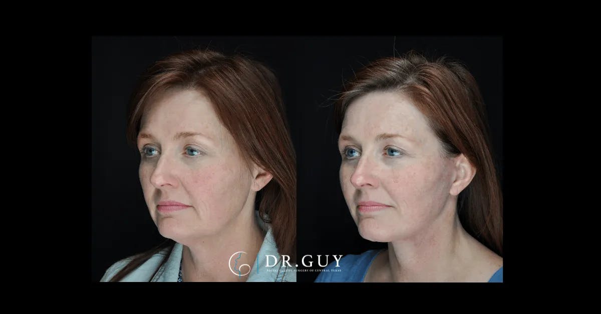 Facelift Before & After Gallery - Patient 240887 - Image 4