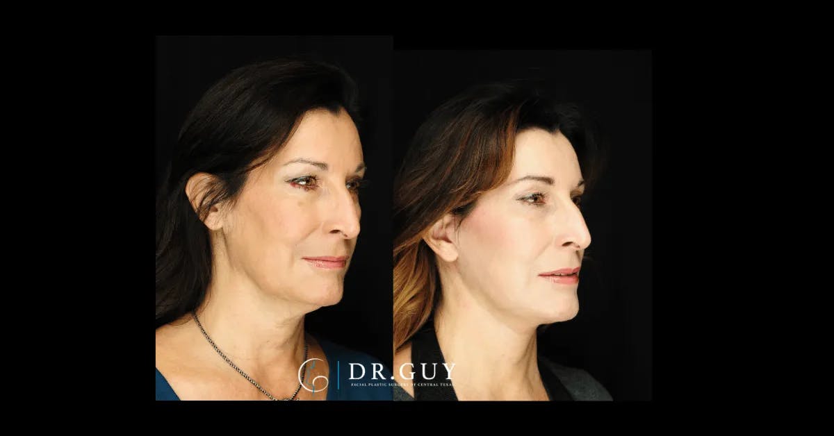 Facelift Before & After Gallery - Patient 347666 - Image 3