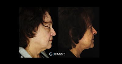 Facelift Before & After Gallery - Patient 290077 - Image 1