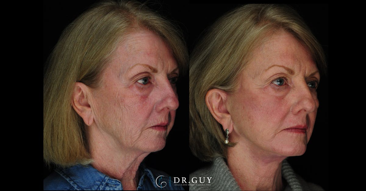 Facelift Before & After Gallery - Patient 342831 - Image 2