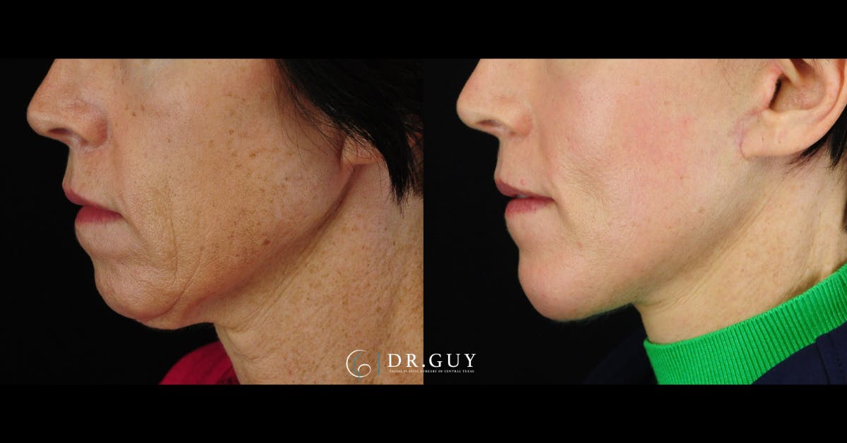 Mini Facelift Before & After Gallery - Patient 416662 - Image 1