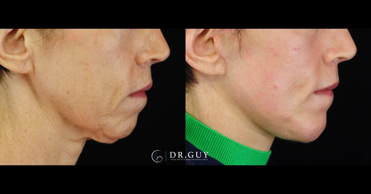 Mini Facelift Before & After Gallery - Patient 416662 - Image 4