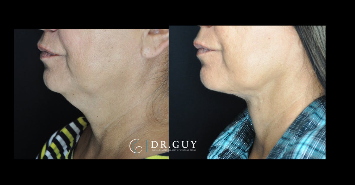 Neck Lift Before & After Gallery - Patient 111588 - Image 2