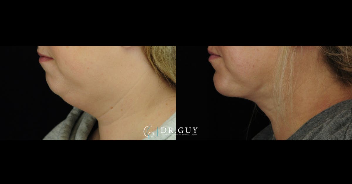 Neck Liposuction Before & After Gallery - Patient 101143 - Image 1