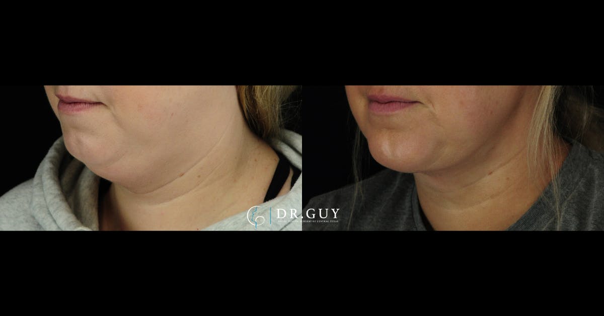 Neck Liposuction Before & After Gallery - Patient 101143 - Image 2