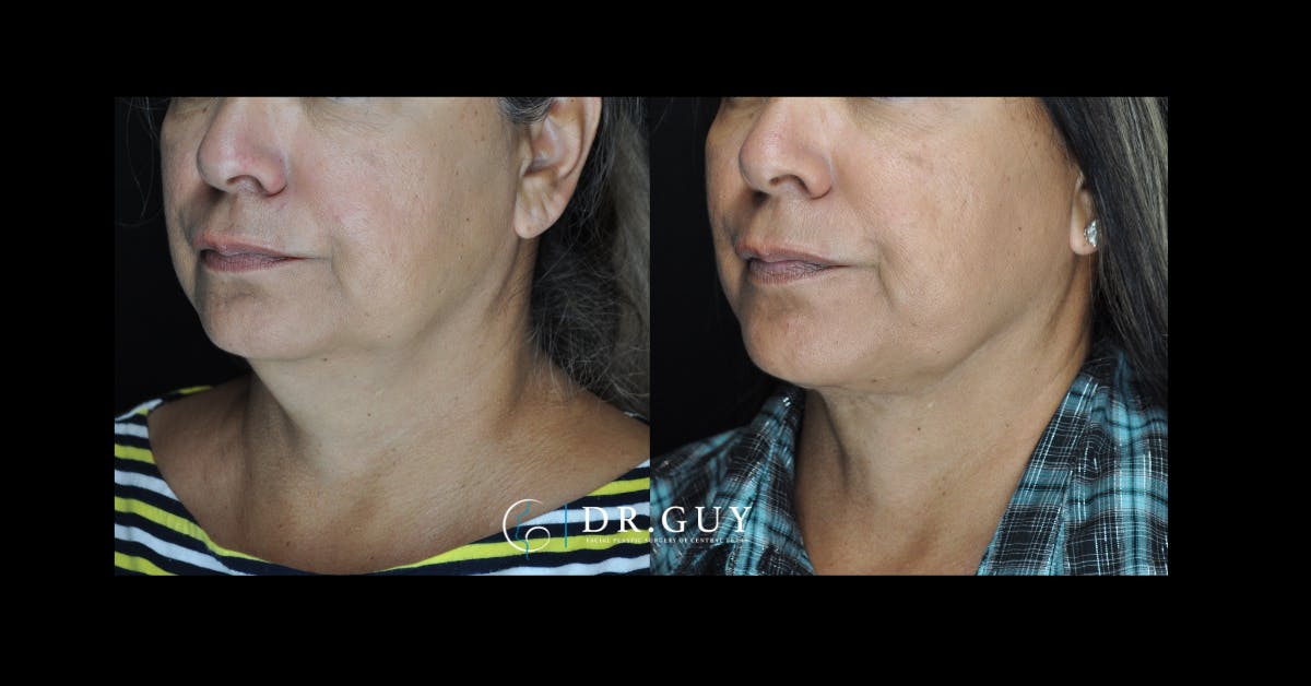 Neck Liposuction Before & After Gallery - Patient 185113 - Image 1