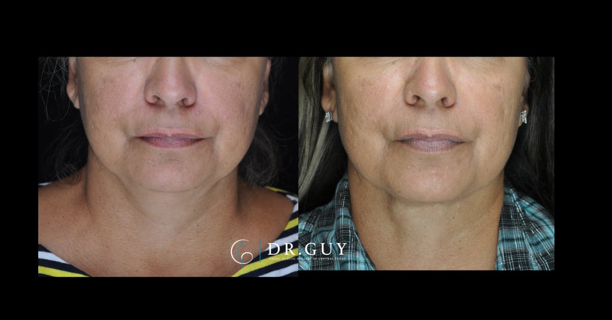Neck Liposuction Before & After Gallery - Patient 185113 - Image 3